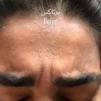 پاکسازی و فیشیال پوست ازبین بردن لک مخصوص بانوان
