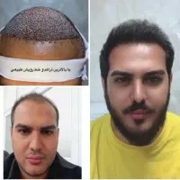 ۵۰٪تخفیف کاشتمو در شیراز|خدمات آرایشگری و زیبایی|خرم‌آباد, |دیوار