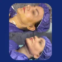 ساکشن غبغب