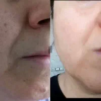 پوستتو مثل آینه کن (سریع / ارزان / بدون درد)