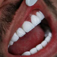 کامپوزیت مونوکروم و لیرینگ به صورت اقساط