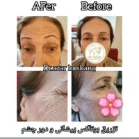 بوتاکس و ژل|خدمات آرایشگری و زیبایی|تهران, مطهری|دیوار