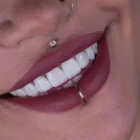 لمینیت ،عصب کشی،ایمپلنت،کامپوزیت