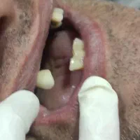 ساخت انواع دندان مصنوعی با قیمت مناسب