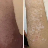 بهبود پیسی و پسوریازیس