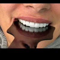 دندانپزشکی ،کامپوزیت ، زیبایی ،