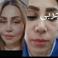 تزریق چربی ساکشن چربی ژل بوتاکس مزو چال گونه|خدمات آرایشگری و زیبایی|قم, بنیاد|دیوار