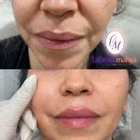 ژل بوتاکس مزوژل جشنواره ۴۹۹ت مزوژل|خدمات زیبایی و سلامت|تهران, سجاد|دیوار