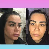 تزریق فیلر ژل و بوتاکس