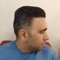 کاشت مو و ابرو
