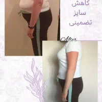 لاغری با طب سوزنی