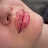 تزریق چربی،ژل و بوتاکس