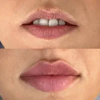 تزریق ژل بوتاکس لیزر هایفو مزو پی ار پی نخ فیشیال|خدمات آرایشگری و زیبایی|شهریار, |دیوار