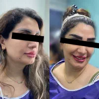 فرصت ویژه و محدود کاشت ابرو