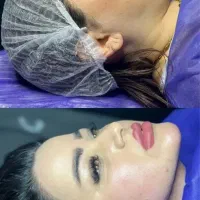 جشنواره ۵۰درصدی ژل و بوتاکس ، ساکشن غبغب|خدمات آرایشگری و زیبایی|کرمانشاه, |دیوار