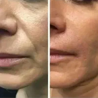 تزریق ژل و بوتاکس با مواد اصل و اورجینال|خدمات آرایشگری و زیبایی|ساری, |دیوار