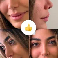 عمل جراحی بینی فقط 28.900 درکرج بدون تامپون(ENT)