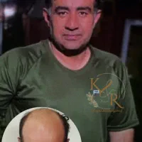کاشت مو با تضمین تراکم