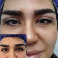 بلفاروپلاستی (پف چشم )، سانترال لب در رشدیه|خدمات آرایشگری و زیبایی|تبریز, |دیوار