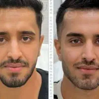 کانتورینگ صورت بوتاکس و مزو تراپی و prp