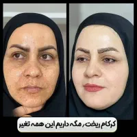 رفع لک و تیرگی صورت و بدن در خانه