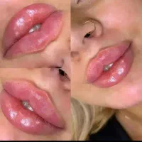 تزریق فیلر‌ و ژل لب و‌بوتاکس با آف ویژه فقط ۱ تومن