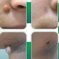 خال،گوشت اضافه
