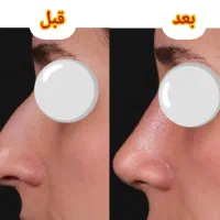 عمل زیبایی بینی|خدمات آرایشگری و زیبایی|زنجان, |دیوار