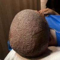 کاشت مو فقط 20 تومن و ابرو فقط ۱۶ تومن