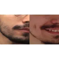 پکیج تقویت تراکم صورت