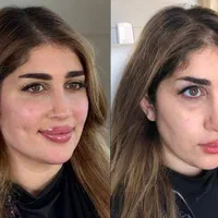 تزریق ژل و بوتاکس طراحی چهره برای زیبایی‌خاص|خدمات آرایشگری و زیبایی|تهران, شادمان|دیوار