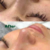 آفر پکیج دو جلسه فیشال تخصصی و درمان تیرگی