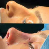 مشاوره تخصصی عمل بینی در لامرد