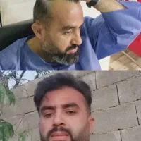 کاشت مو به روش fit