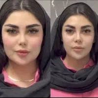 لیزر تزریق چربی،ژل،بوتاکس،prp،مادلینگ ومیدفیس