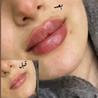 تزریق تخصصی ژل و بوتاکس|خدمات آرایشگری و زیبایی|سبزوار, کوی بهار|دیوار