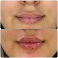 تزریق فیلر (ژل) بوتاکس مزو  در کلینیک ونوس با قی|خدمات آرایشگری و زیبایی|تهران, حر|دیوار
