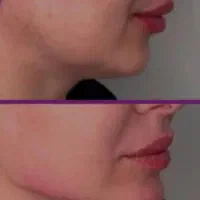 انجام ژل و بوتاکس با بهترین مواد اقساطی|خدمات آرایشگری و زیبایی|آزادشهر, |دیوار