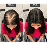 ضدریزش و رویش مجدد مو معجزه اسا جایگزین کاشت