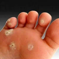 برداشت زیگیل و خالبرداری و میخچه