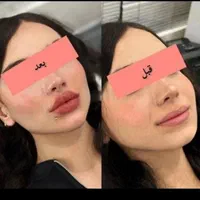 تزریق ژل وبوتاکس