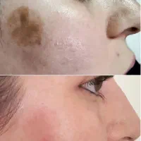 تخفیف لیزر تک جلسه ای تیرگی و کک مک صورت