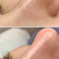 خدمات فیشیال پوست صورت|خدمات آرایشگری و زیبایی|کرج, فاز ۲ مهرشهر|دیوار