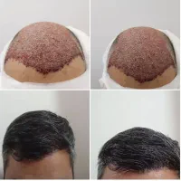 کاشت مو۱۰۰درصدطبیعی باخط رویش دلخواه