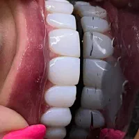 کامپوزیت بدون تراش وبا ضمانت از واحدی 800 اقساطی