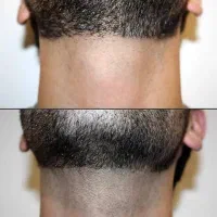 جشنواره زمستانه لیزرموهای زائد ریزش تضمینی در مطب|خدمات آرایشگری و زیبایی|زنجان, |دیوار