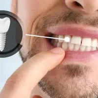 ایمپلنت دندان اقساطی بدون کارمزد