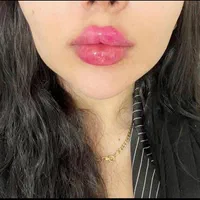 تزریق فیلربینی ژل لب