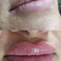 بوتاکس ژل لب
