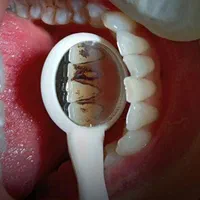 جرمگیری دندان بدون هزینه درمانگاه نگار|خدمات آرایشگری و زیبایی|محمدیه-قزوین, |دیوار